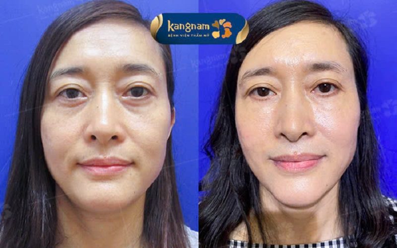Cắt mí dưới giấu chỉ khắc phục được khuyết điểm vùng mí dưới