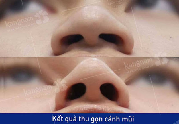 Khách hàng phục hồi nhanh chóng sau thu gọn cánh mũi.