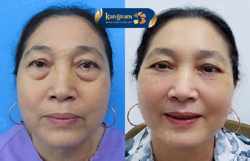 Sau một thời gian bọng mỡ mắt có thể tích tụ nếu cơ thể nhanh lão hóa