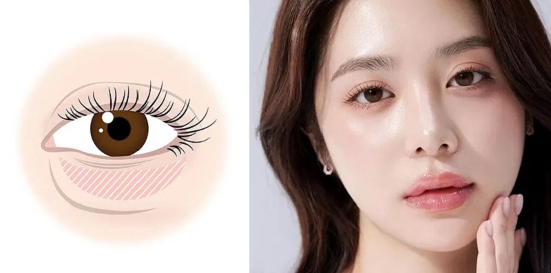 Nếu mí mắt bị tích tụ mỡ nhanh có thể hình thành bọng mắt