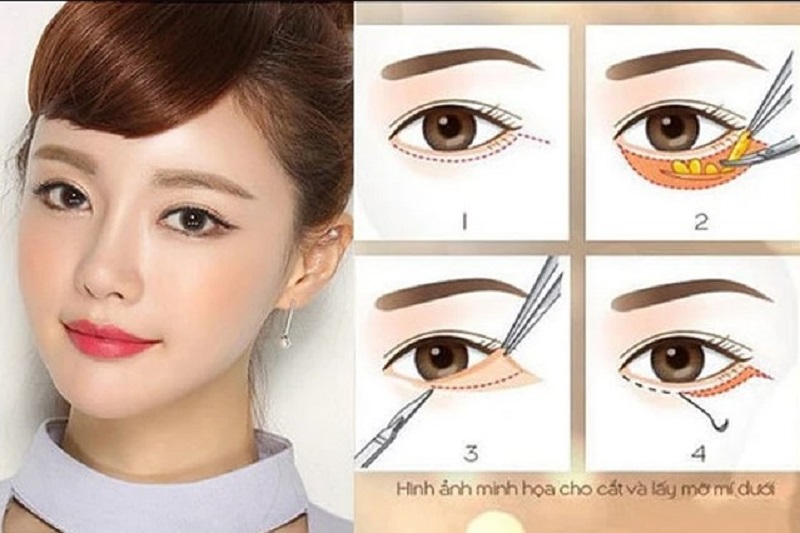 Kỹ thuật cắt rạch không chính xác có thể để lại mỡ mắt