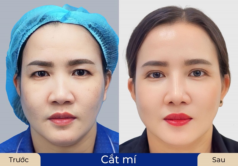Thực hiện cắt mí để khắc phục tình trạng mắt bị sụp