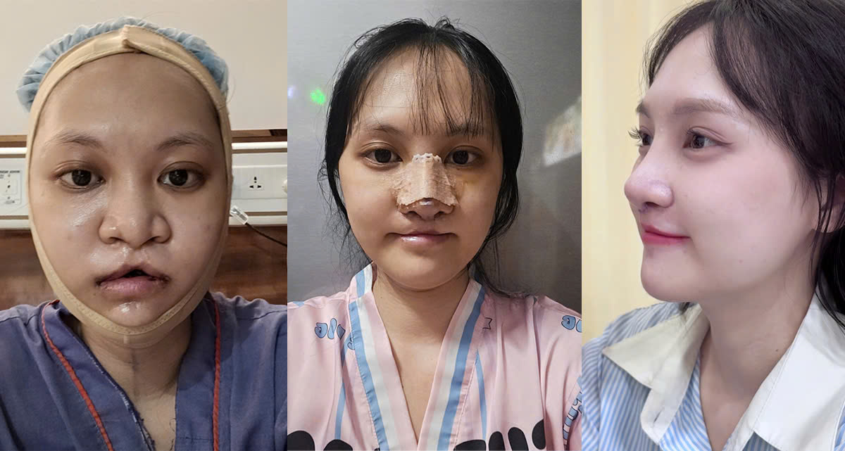 Giai đoạn phục hồi sau nâng mũi