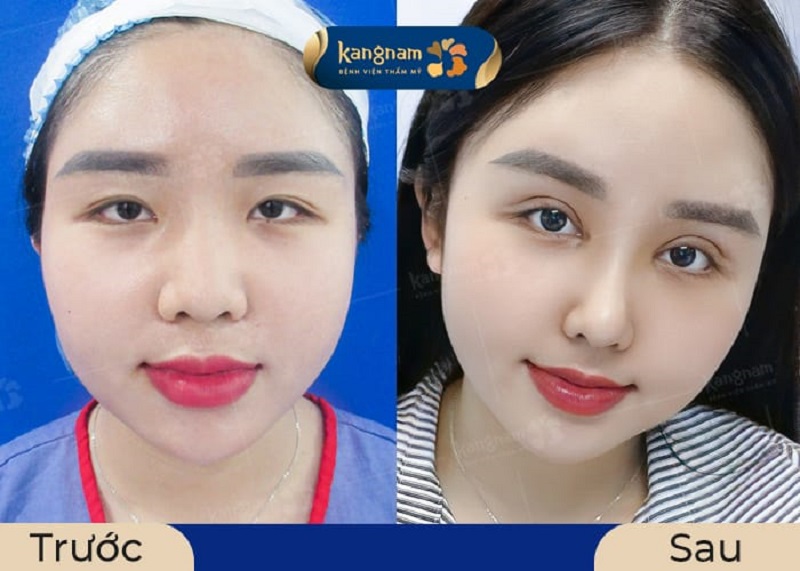 Mắt sẽ ổn định và đẹp tự nhiên sau khoảng 1 tháng