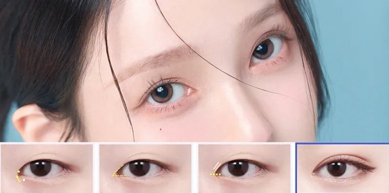 Mở rộng góc mắt sẽ lành lại sau vài ngày
