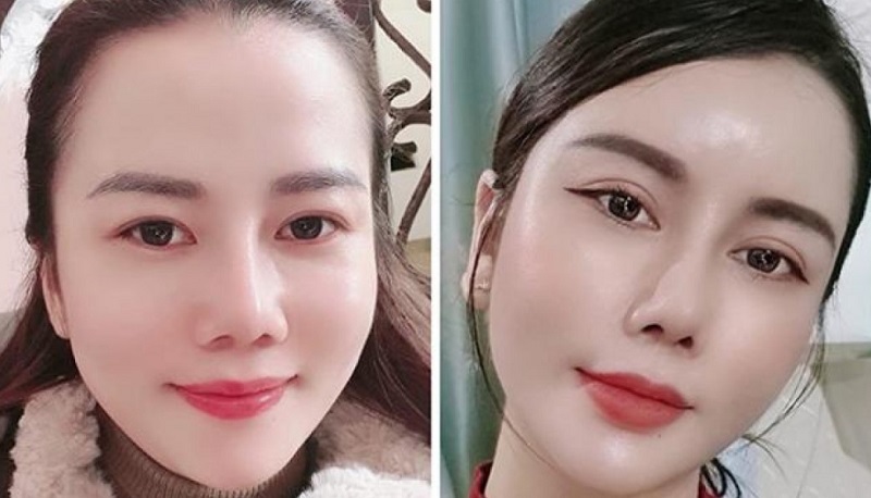 Mắt giọt lệ tạo độ tươi trẻ, cuốn hút cho khuôn mặt