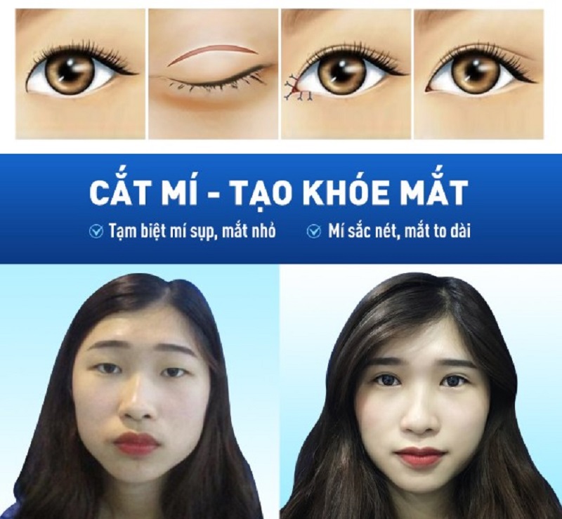 Kangnam tạo khóe mắt trong đúng quy trình, đảm bảo an toàn