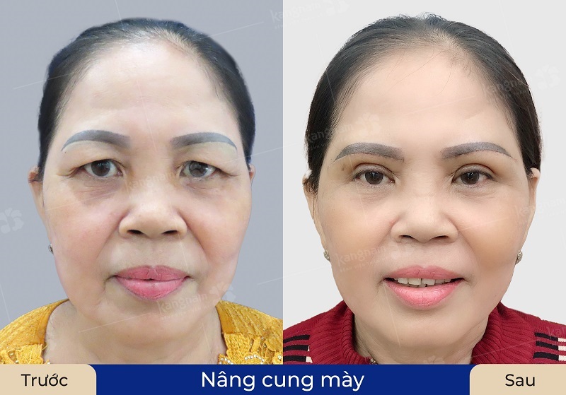 Vết thương phục hồi ổn định sau nâng cung chân mày khách hàng mới nên xăm mày