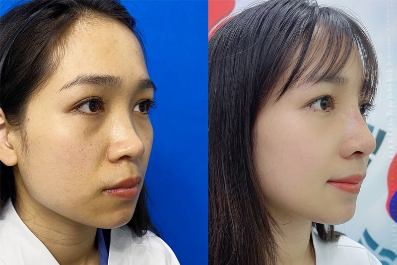Mũi cấu trúc kết hợp sụn tự thân có độ tương thích cao, ít biến chứng