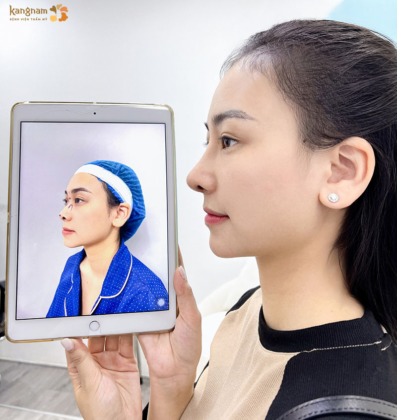 Chất liệu sụn sinh học cao cấp giúp kéo dài tuổi thọ dáng mũi