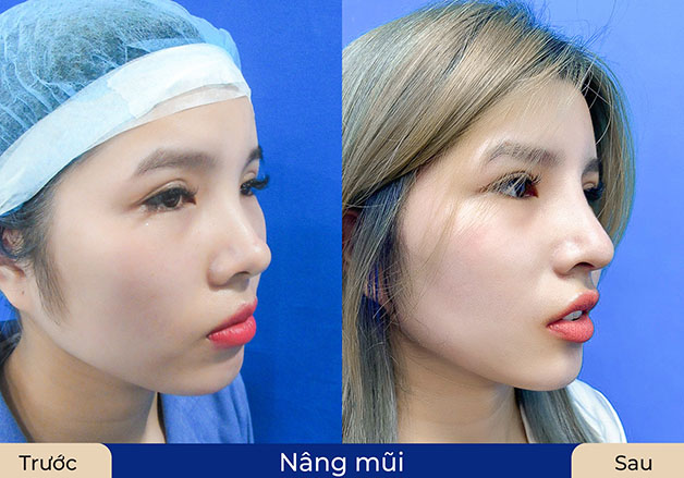 Khách hàng nâng mũi tại Kangnam ít sưng đau, hồi phục nhanh chóng