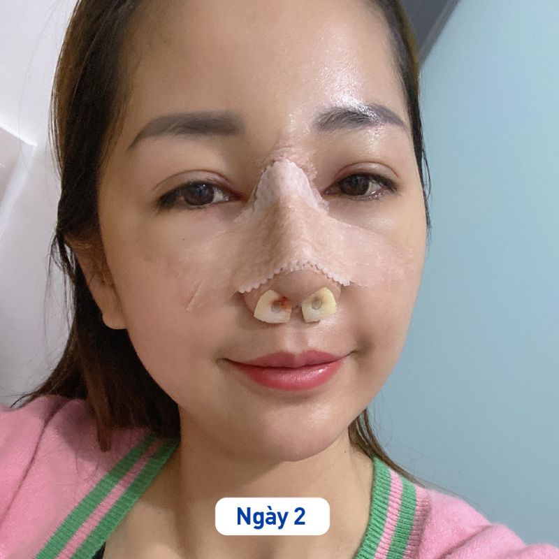 Tình trạng sưng phổ biến sau 1–3 ngày phẫu thuật mũi