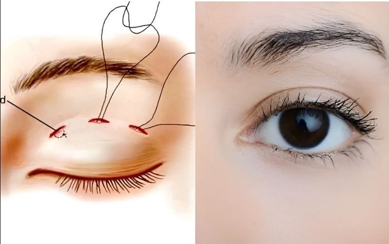 Nhấn mí phù hợp với những người có mí mắt ít khuyết điểm