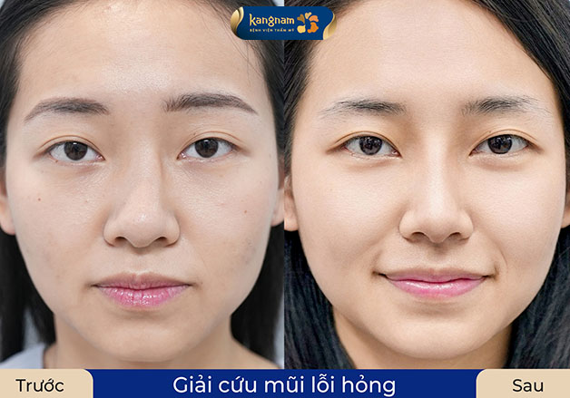 Khách hàng thực tế tại Kangnam sau khi chỉnh hình vách ngăn mũi