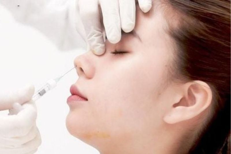 Tiêm filler nâng mũi giúp cải thiện sống mũi nhanh chóng