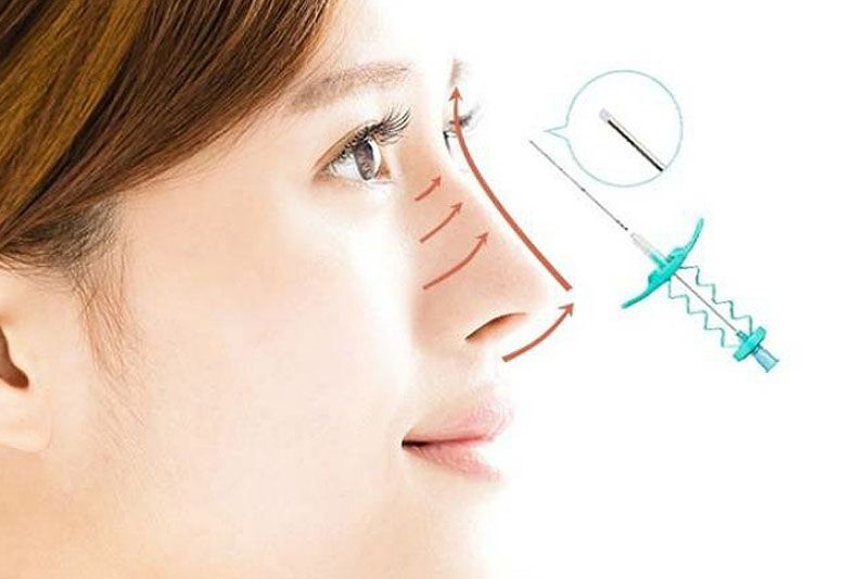 Chỉ sinh học được cấy dưới da để định hình sống mũi