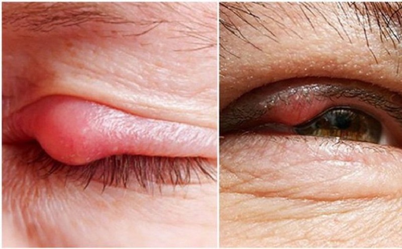Một số bệnh lý nguy hiểm gây sưng mí mắt