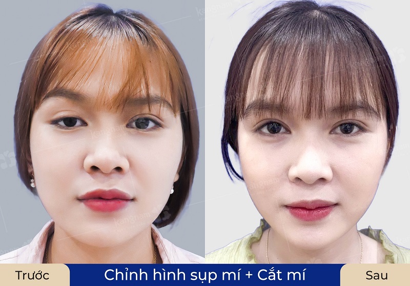 Chỉnh hình sụp mí khắc phục tình trạng mí mắt bị trễ