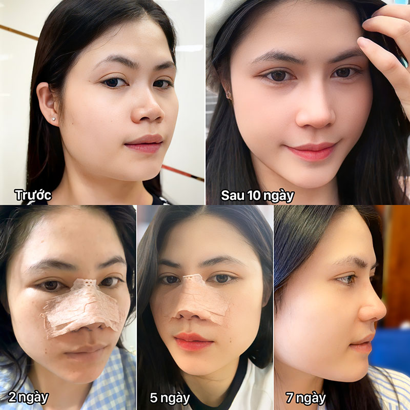 Hình ảnh so sánh trước – sau 7 ngày phẫu thuật mũi
