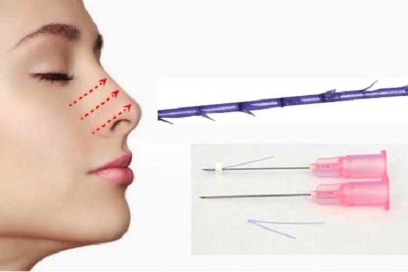 Cuộn cánh mũi bằng chỉ là phương pháp không phẫu thuật, sử dụng chỉ sinh học PDO hoặc chỉ vàng để luồn vào hai bên cánh mũi