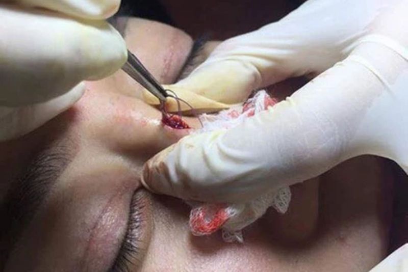 Khách hàng gặp biến chứng cần tháo chỉ mũi