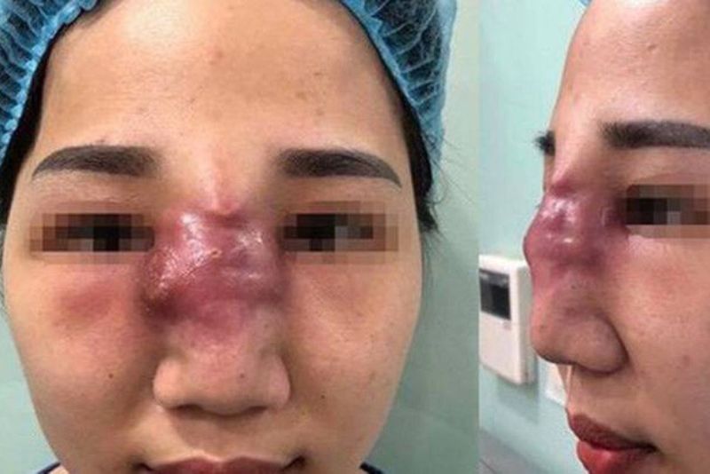 Biến chứng do tiêm filler sai kỹ thuật