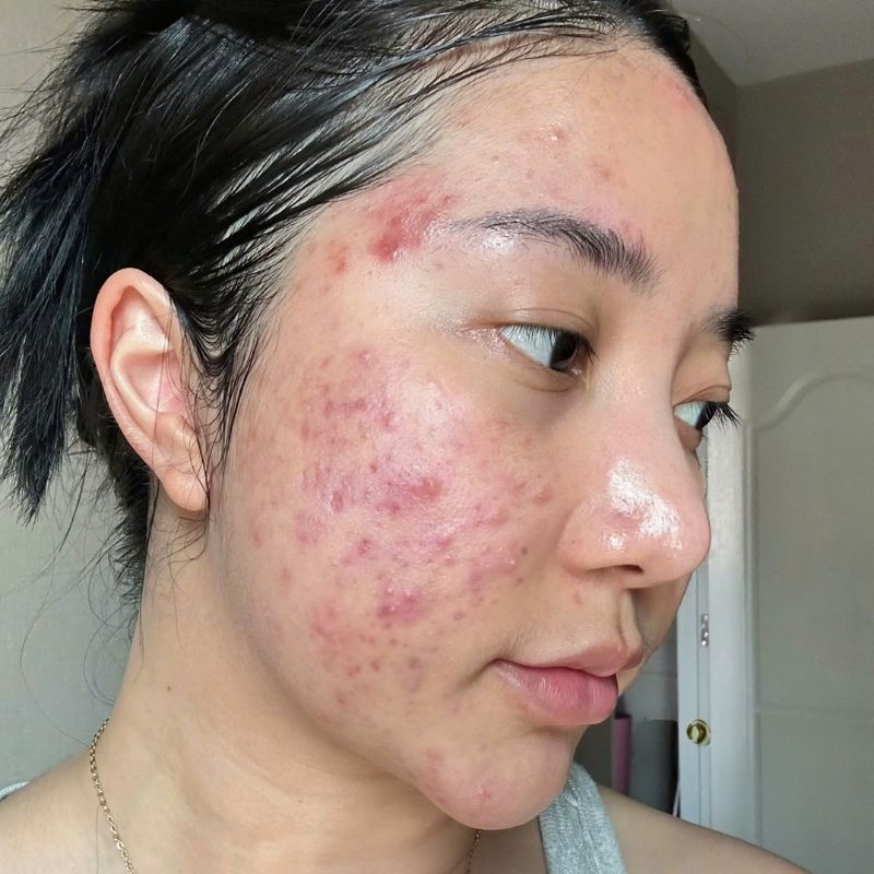 Thâm và mụn mức độ nặng cần thăm khám bác sĩ da liễu