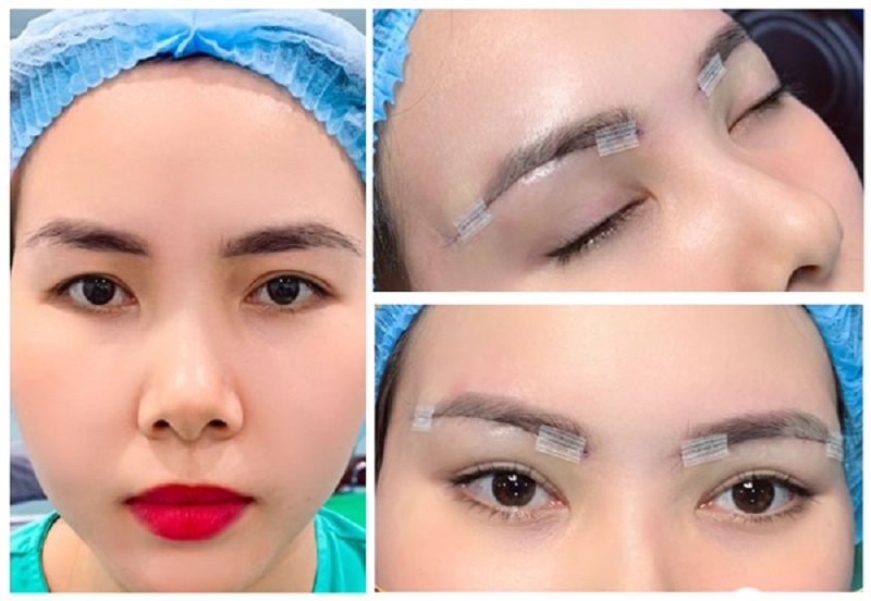 Treo cung chân mày khắc phục tình trạng lão hóa, da chùng nhão