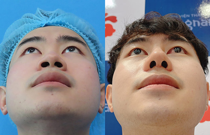 Dáng mũi thon gọn tự nhiên
