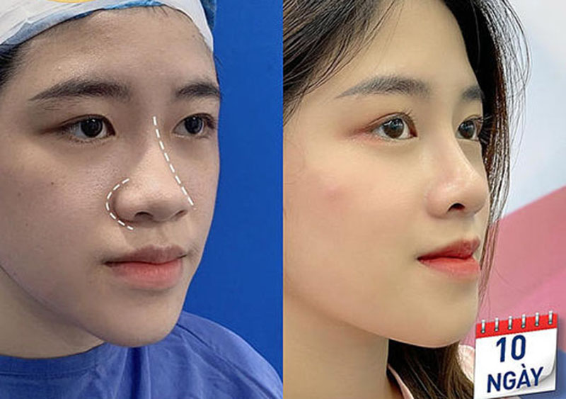 Góc nghiêng cho thấy sự thay đổi sau khi thu gọn cánh mũi