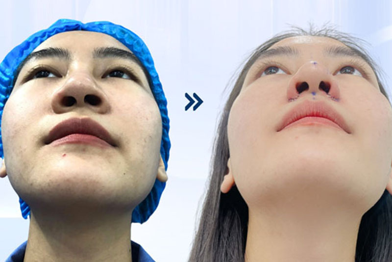 Mũi biến dạng bên cao bên thấp và sau khi được chỉnh sửa
