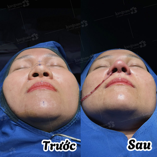 Nâng mũi cấu trúc không gây đau trong quá trình phẫu thuật