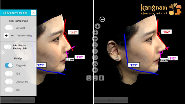 Kangnam ứng dụng AI Face Design trong quá trình nâng mũi