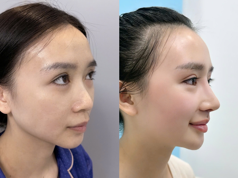 trường hợp khách hàng chỉ cần nâng cao sống mũi đã hài hòa, vì đầu mũi ban đầu gọn sẵn