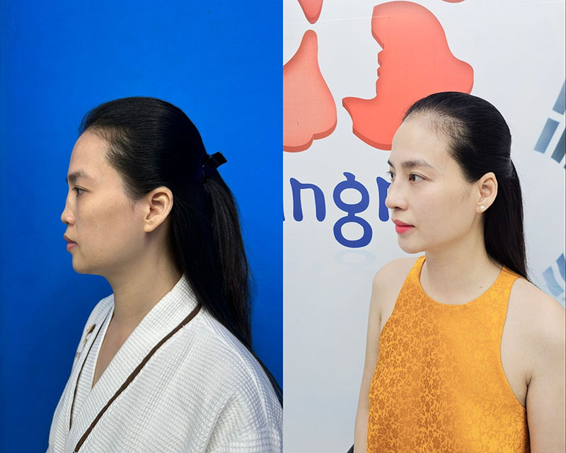 Chị Lê Thu Hà mũi hỏng nặng, từng đi sửa nhiều nơi bị từ chối và sau khi được bác sĩ Kangnam tiếp nhận chỉnh sửa, chị sở hữu dáng mũi cân đối, hài hòa