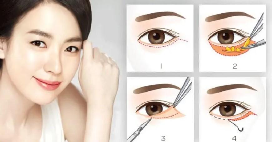 Bóc bọng mắt dưới giúp đôi mắt tươi trẻ hơn