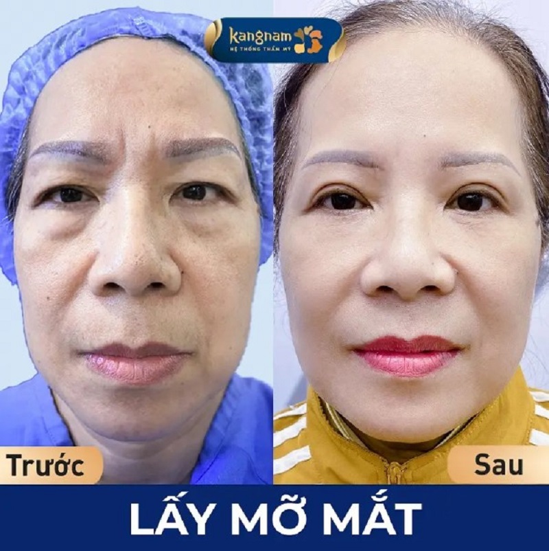 Lấy mỡ mắt giúp đôi mắt tươi sáng, trẻ trung hơn