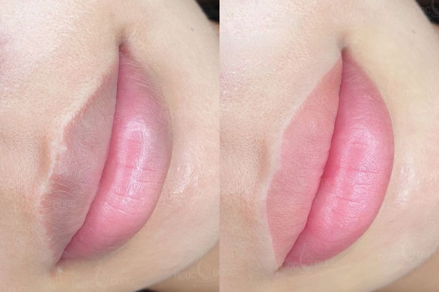Đôi môi hồng hào, tươi tắn sau khử thâm