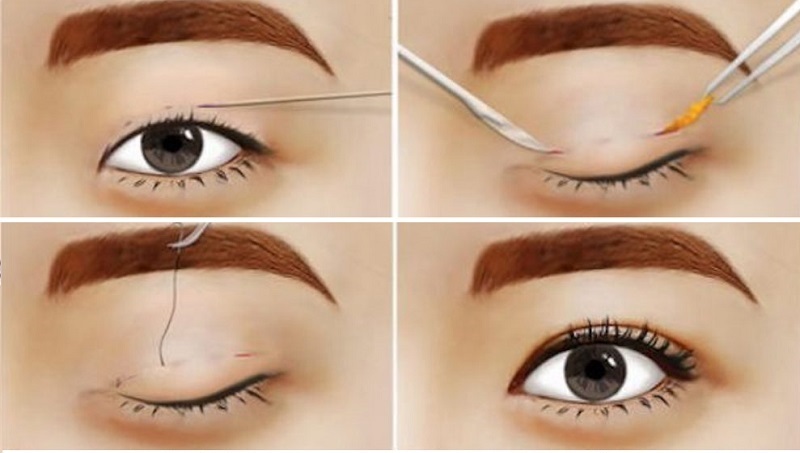 Sử dụng chỉ chuyên dụng để tạo liên kết nếp mí mới