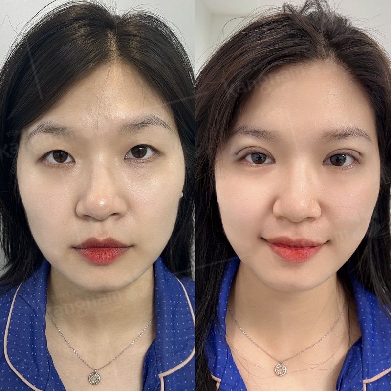 Nhấn mí mang lại đôi mắt sắc nét, cân đối