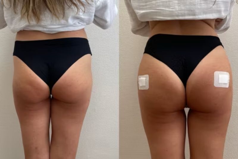 So sánh dáng mông trước và sau 1 tuần tiêm filler