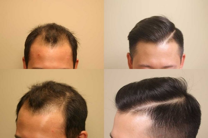 Nên chọn cấy tóc tại cơ sở thẩm mỹ uy tín để đảm bảo kết quả tốt