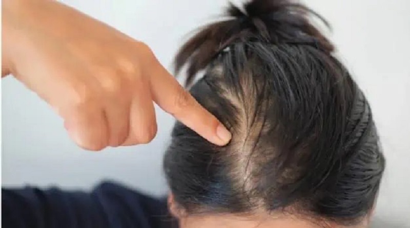 Chi phí cấy tóc sẽ phụ thuộc vào tình trạng của mỗi người