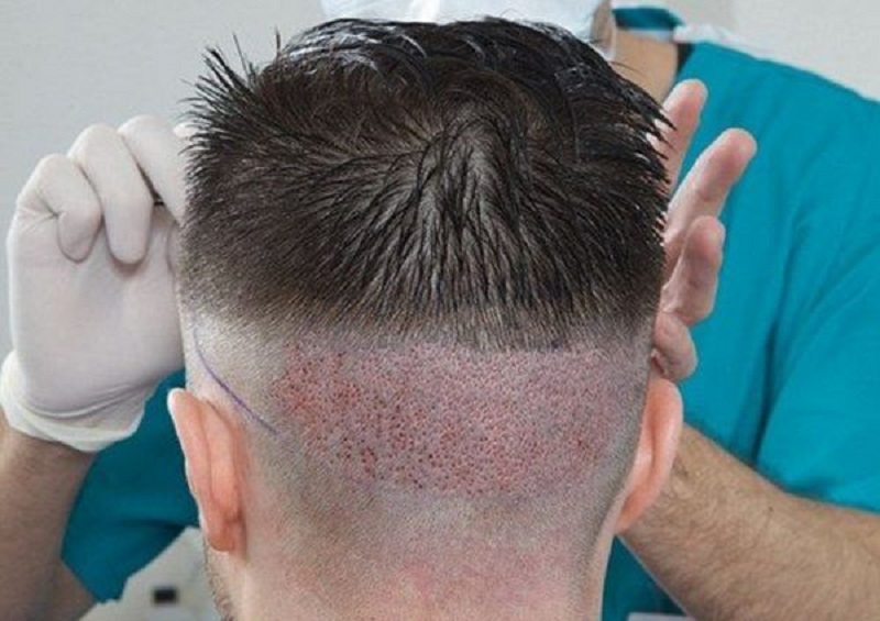Những kỹ thuật cấy tóc hiện đại sẽ có chi phí cấy tóc cao hơn
