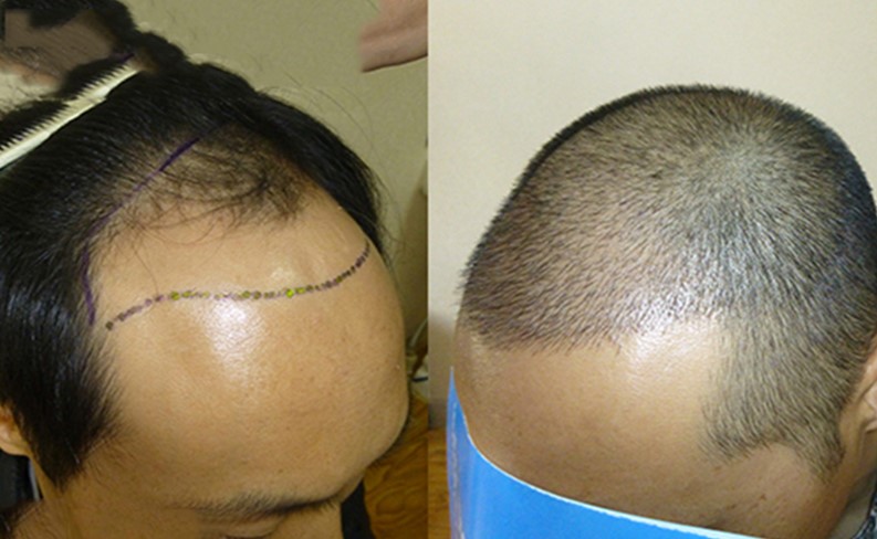 Sau vài tháng tóc cấy sẽ ổn định và bóng mượt hơn