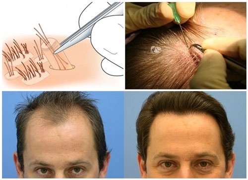 Tóc có thể rụng thời gian đầu sau cấy