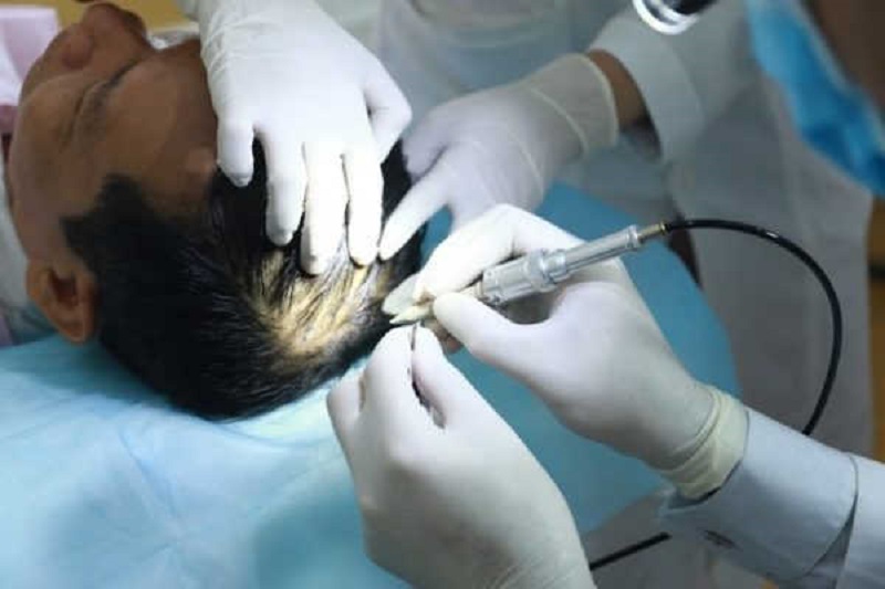 Bác sĩ sẽ thăm khám và tư vấn phác đồ cấy tóc phù hợp