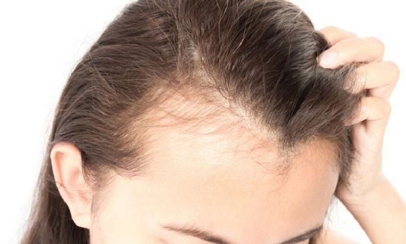 Chi phí cấy tóc chữ M rất đa dạng