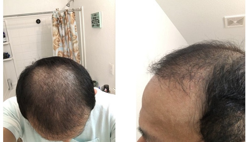 Nang tóc mới phát triển dày và đều màu
