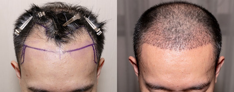 Thực hiện cấy tóc tại cơ sở thẩm mỹ uy tín để đảm bảo an toàn